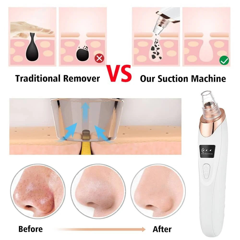Electric Blackhead Remover | Vacuum Acne & Pore Cleaner | 5 Heads Suction Machine | Skin Care & Exfoliating Tool - Detail View 5